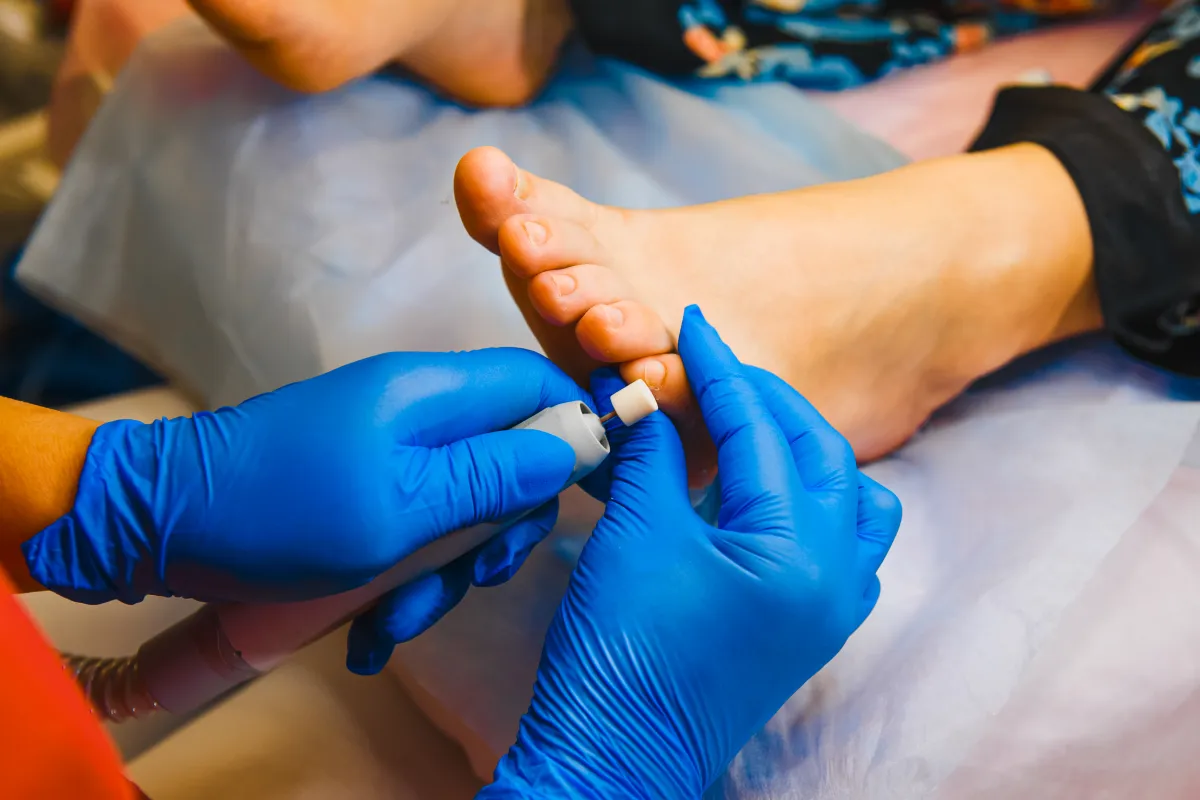 Hongos en las uñas (onicomicosis): por qué aparecen y cómo se tratan con láser